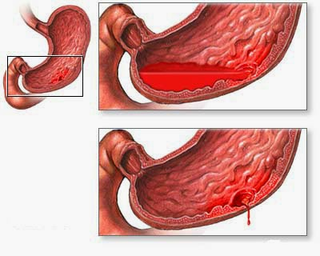 Illustration for article titled Obat Maag Kapsul